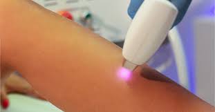 Epilazione con Laser a diodo 808